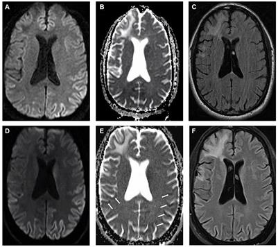 Creutzfeldt-Jakob disease presenting as psychiatric disorder: case presentation and systematic review